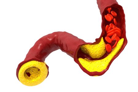Cholesterol plaque in artery.3d renderの写真素材