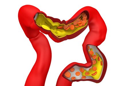 Cholesterol plaque in artery.3d renderの写真素材