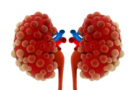 kidney diseaseの写真素材