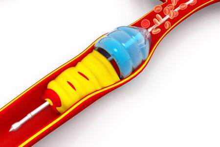 Angioplasty with stent placementの写真素材