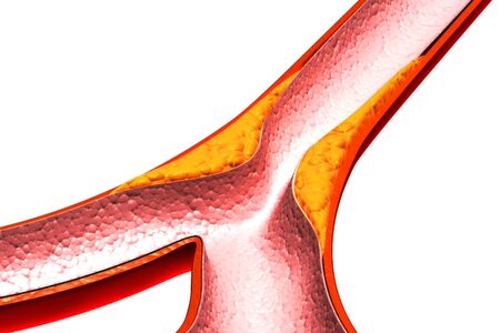 Cholesterol plaque in artery.3d renderの写真素材