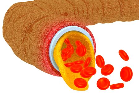 Artery blocked with cholesterol.3d renderの写真素材