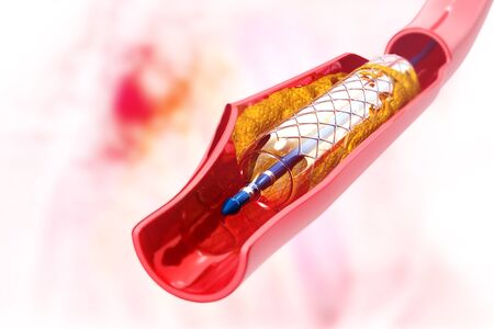 Stent angioplasty. 3d illustration

の写真素材