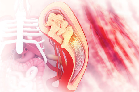 Stent angioplasty. 3d illustration