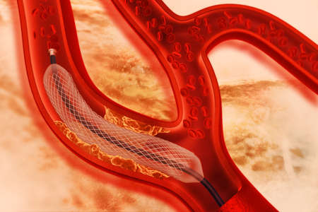Stent angioplasty. 3d illustrationの写真素材
