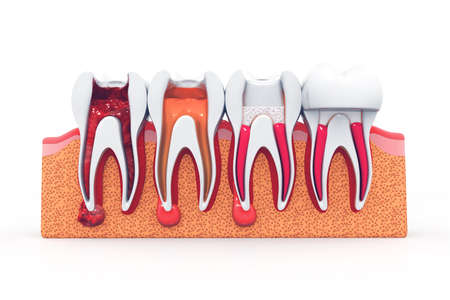 stages of root canal treatmentの写真素材