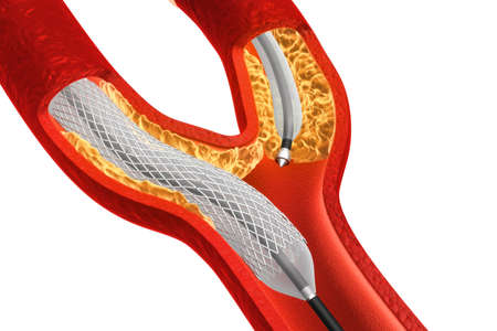 Balloon Expandable Stent. Anatomical conceptの写真素材