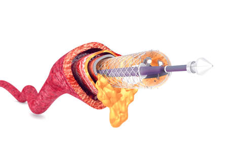 Balloon Expandable Stent. Anatomical conceptの写真素材
