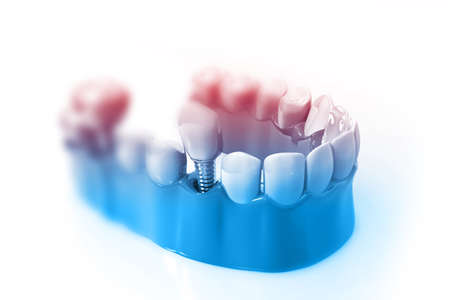 Tooth implant instalation process. 3d renderの写真素材