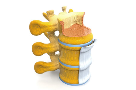 Spinal Stenosis 3d render