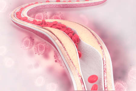 Cholesterol plaque in arteryの写真素材