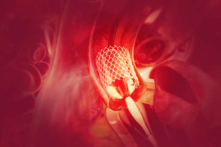 Stent angioplasty. 3d illustrationの写真素材