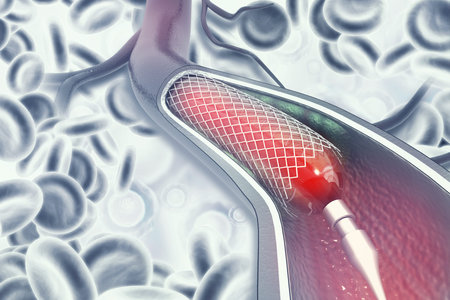 Stent angioplasty.3d illustration