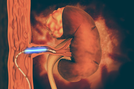 Stent angioplasty. Peripheral artery disease. 3d illustration