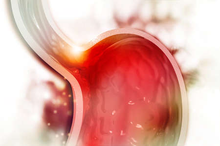Cholesterol plaque in artery. Stomach cross section. 3d illustrationの写真素材