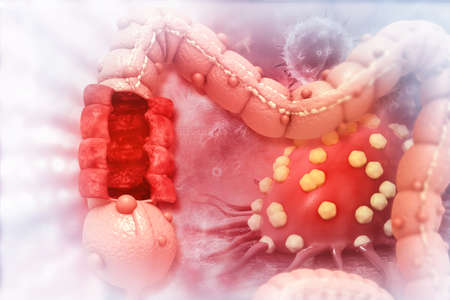 Colon cancer. Cancer attacking cell. Colon disease concept. 3d illustrationの写真素材