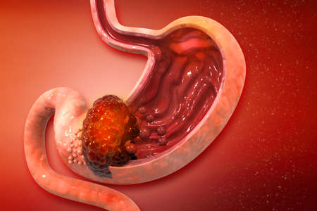 Stomach cancer. Cancer attacking cell. Stomach disease concept. 3d illustrationの写真素材