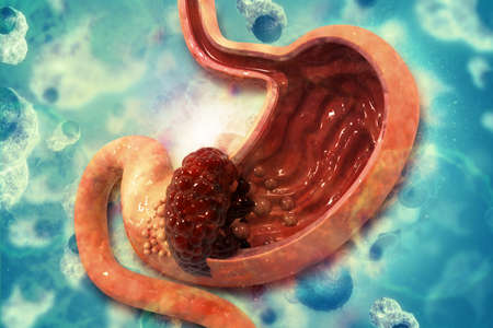 Stomach cancer. Cancer attacking cell. Stomach disease concept. 3d illustrationの写真素材