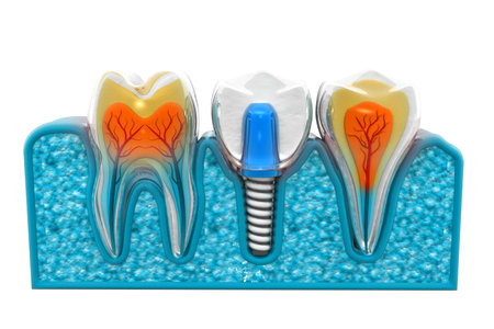 Tooth implant installation process 3d render