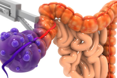 Appendix surgery. 3d render