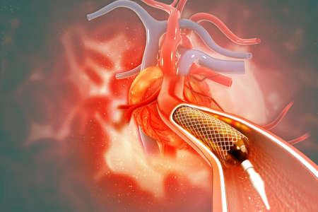 Stent angioplasty on scientific background. 3d illustrationの写真素材