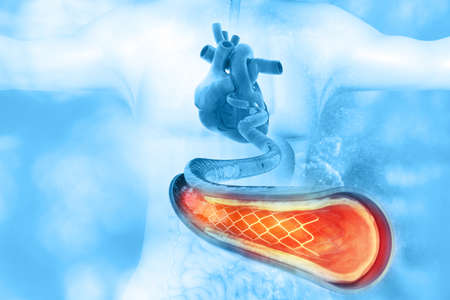 Stent angioplasty on scientific background. 3d illustrationの写真素材