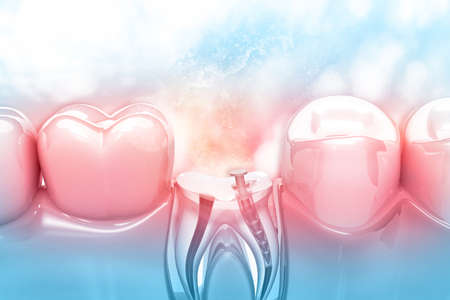 Dental implant installation process. 3d illustrationの写真素材
