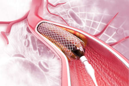 Stent angioplasty on scientific background. 3d illustrationの写真素材