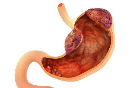 Stomach cancer. Cancer attacking cell. Stomach disease concept. 3d illustration