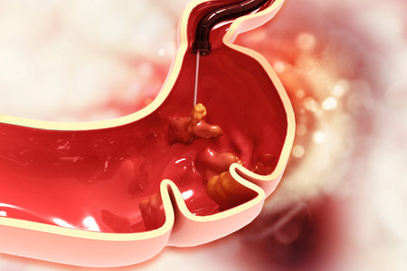 Stomach cancer. Cancer attacking cell. Stomach disease concept. Removing cancer cells. 3d...