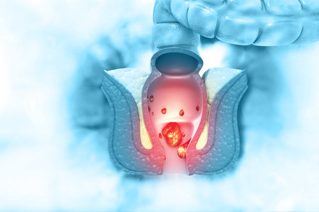 Haemorrhoids (piles) on scientific background. 3d illustration