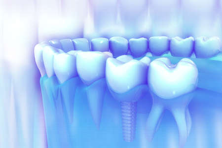 Dental implant installation process. 3d illustrationの写真素材