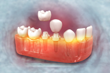 Dental implant installation process. 3d illustration