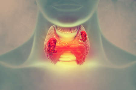 Thyroid gland cancer. showing thyroid gland with tumor. 3d illustrationの写真素材