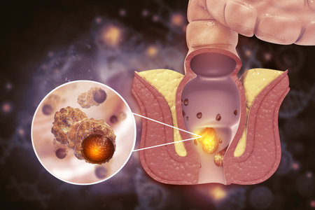 Haemorrhoids (piles) on scientific background. 3d illustration