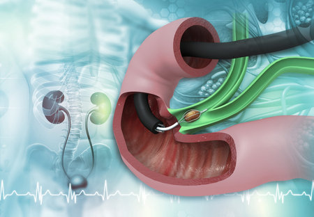 Kidney stone removal concept background. 3d illustration