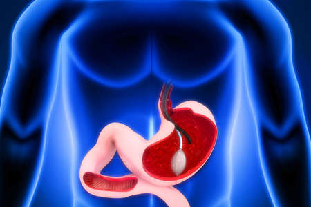 Stomach Endoscopy. Gastric Balloon Inside a Stomach. 3d illustrationの写真素材