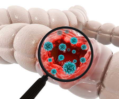 Colon cancer. Cancer attacking cell. Colon disease concept. 3d illustrationの写真素材