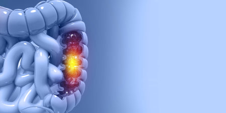Medical illustration of colon cancer concept. 3d illustration