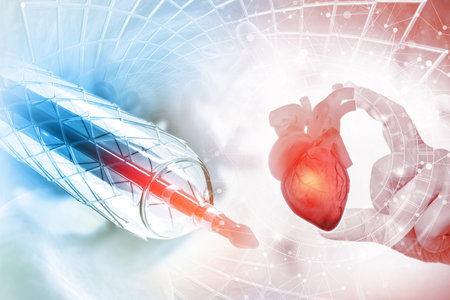 Stent and catheter for implantation into blood vessels. 3d illustrationの素材 [FY310204408834]