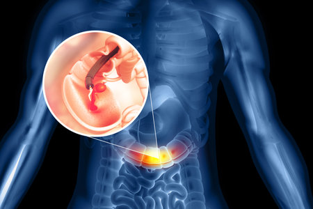 Colon cancer. colonoscope in the colon. polyp removal. 3d illustrationの写真素材