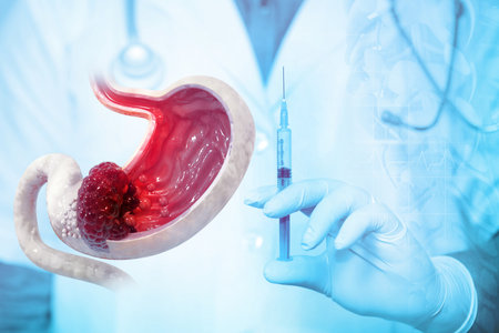 Stomach cancer treatment concept. Stages of development of a malignant tumour or cancer of the stomach. cancer therapy, injection. 3d illustrationの写真素材