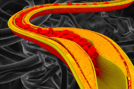 Cholesterol blocked artery. The accumulation of cholesterol in the blood vessels. 3d illustrationの素材