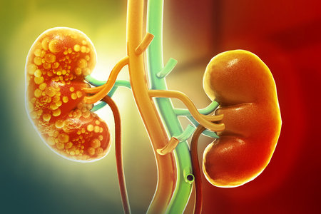 Chronic Kidney Disease. Medical organ. Cross section. 3d illustration