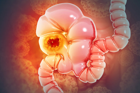 Colon cancer. Cancer attacking cell. Colon disease concept. 3d illustrationの写真素材