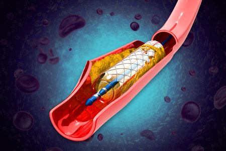 Stent angioplasty. cholesterol blocked artery. The accumulation of cholesterol in the blood vessels. 3d illustrationの写真素材
