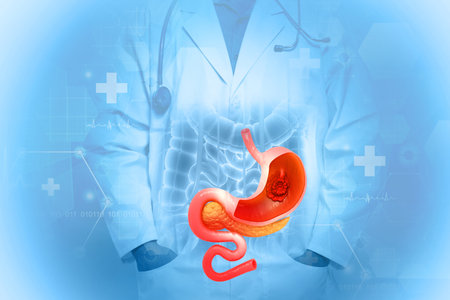 Stomach cancer, gastric cancer, symptoms, stages, treatment, 3d illustrationの写真素材