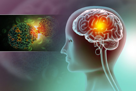 Brain cancer, showing presence of tumor inside brain. 3d illustrationの写真素材