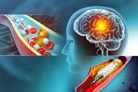 Atherosclerosis Stroke. A blood clot in the vessels of the human brain. Stent angioplasty. 3d illustrationの写真素材