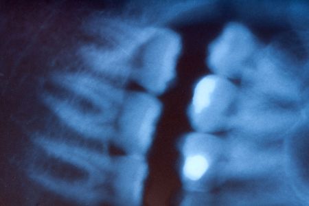 a dental x-ray detailの写真素材